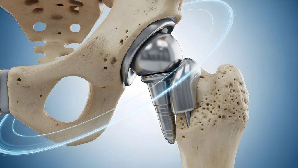 signs you need a hip replacement